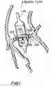 Fig. 02 - Artificial heart valve attachment apparatus and methods