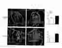 Fig. 11 - Nephropathy-associated gene