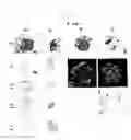Fig. 12 - Nephropathy-associated gene