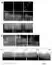 Fig. 05 - Eph/ephrin mediated modulation of cell adhesion and tumour cell metastasis