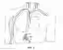 Fig. 02 - Methods and apparatus for treatment of aneurysmal tissue