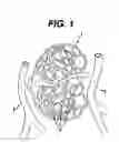 Fig. 02 - Systems and methods for occluding a blood vessel