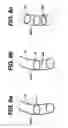 Fig. 07 - Systems and methods for removing plaque from a blood vessel