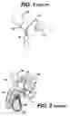 Fig. 02 - Artificial sphincter with variable viscosity fluid-filled collar