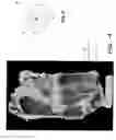 Fig. 04 - Vertebral implant for bone fixation or interbody use