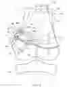 Fig. 04 - Orthopedic device and method for correcting angular bone deformity