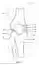 Fig. 02 - Instrumentation for knee resection