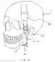 Fig. 06 - Orthopedic instrument