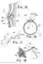 Fig. 08 - Method and apparatus for augmentation of a sphincter