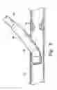 Fig. 06 - Anastomosis device and method