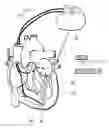 Fig. 01 - Biventricular cardiac pacemaker for cardiac resynchronisation therapy