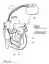 Fig. 02 - Biventricular cardiac pacemaker for cardiac resynchronisation therapy