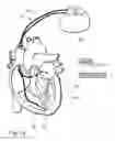 Fig. 03 - Biventricular cardiac pacemaker for cardiac resynchronisation therapy