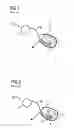 Fig. 02 - Implantable pacemaker