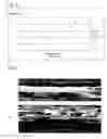 Fig. 02 - Fugitive plasticizer balloon surface treatment for enhanced stent securement