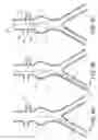 Fig. 07 - Endoluminal prosthesis adapted to resist migration and method of deploying the same