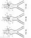 Fig. 08 - Endoluminal prosthesis adapted to resist migration and method of deploying the same
