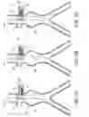 Fig. 09 - Endoluminal prosthesis adapted to resist migration and method of deploying the same