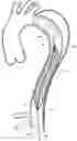 Fig. 01 - Device for treating aortic dissection
