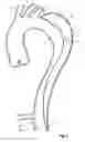 Fig. 02 - Device for treating aortic dissection