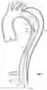 Fig. 06 - Device for treating aortic dissection