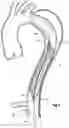 Fig. 07 - Device for treating aortic dissection