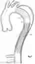 Fig. 08 - Device for treating aortic dissection