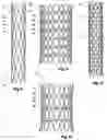 Fig. 09 - Device for treating aortic dissection