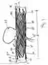 Fig. 02 - Medical devices including metallic films and methods for loading and deploying same