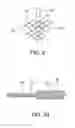 Fig. 04 - Low profile stent-graft attachment