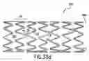 Fig. 43 - Endoprosthesis having foot extensions