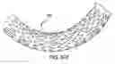 Fig. 45 - Endoprosthesis having foot extensions