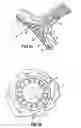 Fig. 02 - Method and devices for decreasing elevated pulmonary venous pressure