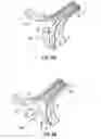 Fig. 06 - Method and devices for decreasing elevated pulmonary venous pressure
