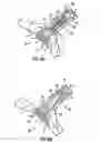 Fig. 07 - Method and devices for decreasing elevated pulmonary venous pressure