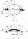 Fig. 06 - Refractive intraocular implant lens and method