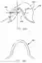 Fig. 07 - Refractive intraocular implant lens and method