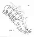 Fig. 02 - Method and apparatus for implant stability