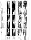 Fig. 06 - Volume maintaining osteoinductive/osteoconductive compositions