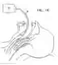 Fig. 03 - Characterization of arteriosclerosis by optical imaging