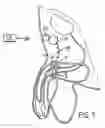 Fig. 02 - Electrically operable impotence treatment apparatus