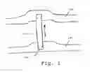 Fig. 02 - Ambulatory spinal unloading method and apparatus