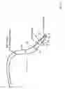 Fig. 03 - Retrograde perfusion of tumor sites
