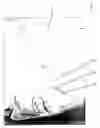 Fig. 09 - Retrograde perfusion of tumor sites