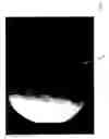 Fig. 10 - Retrograde perfusion of tumor sites