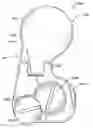 Fig. 01 - Inter-cervical facet implant with locking screw and method