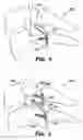 Fig. 04 - Inter-cervical facet implant with locking screw and method