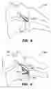 Fig. 06 - Inter-cervical facet implant with locking screw and method