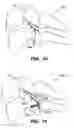 Fig. 07 - Inter-cervical facet implant with locking screw and method