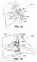 Fig. 09 - Inter-cervical facet implant with locking screw and method